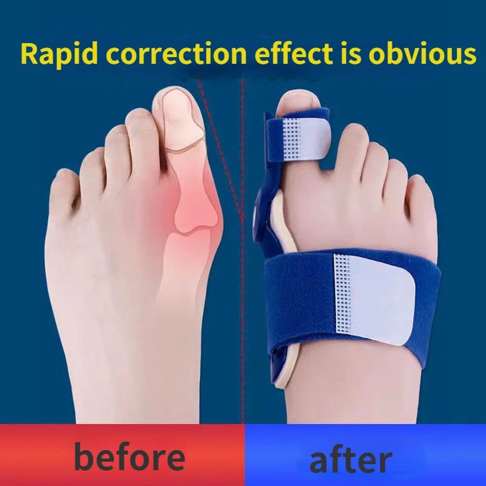 Corrector de férula para juanete, Corrector para aliviar el dolor en el pie, Hallux Valgus, Protector para el cuidado de los pies, 1 unidad/2 uds. 